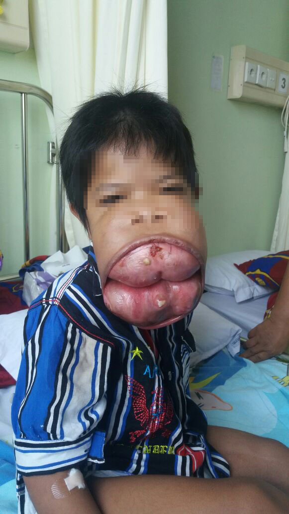 Pelindo III Sukses Mendukung Operasi Bocah Penderita Tumor Gusi Langka